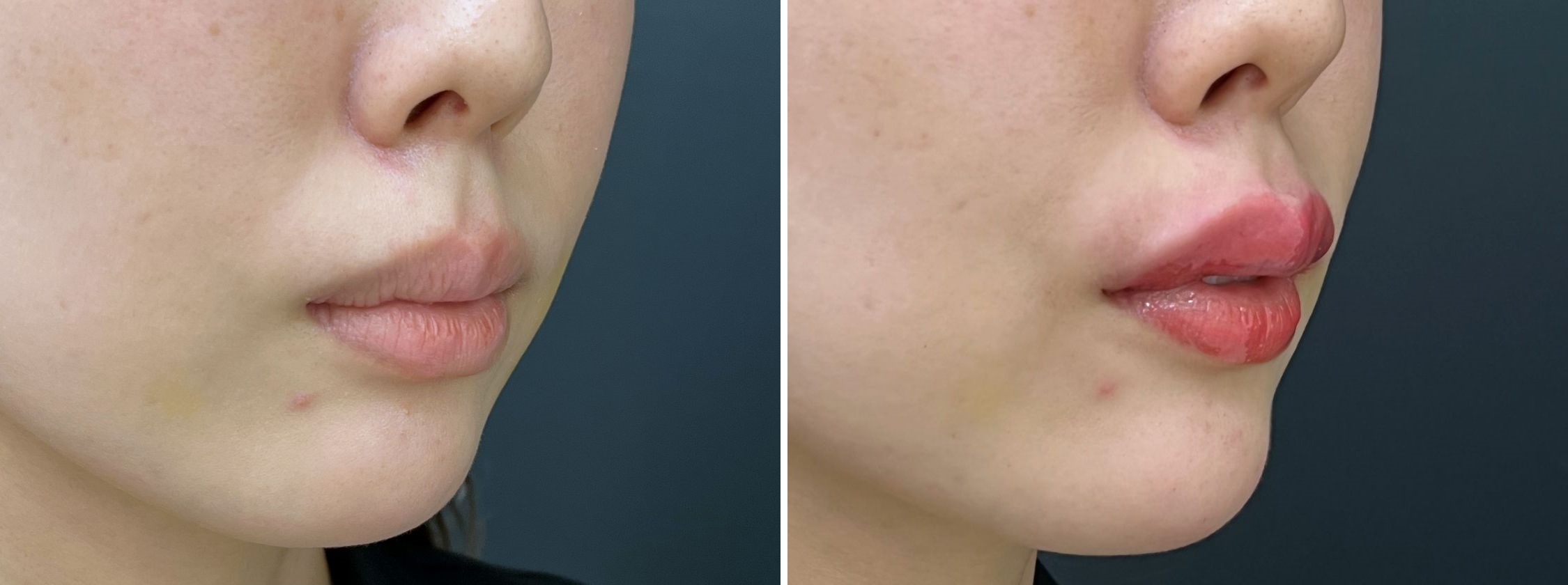 ぽてっとふっくら唇へ