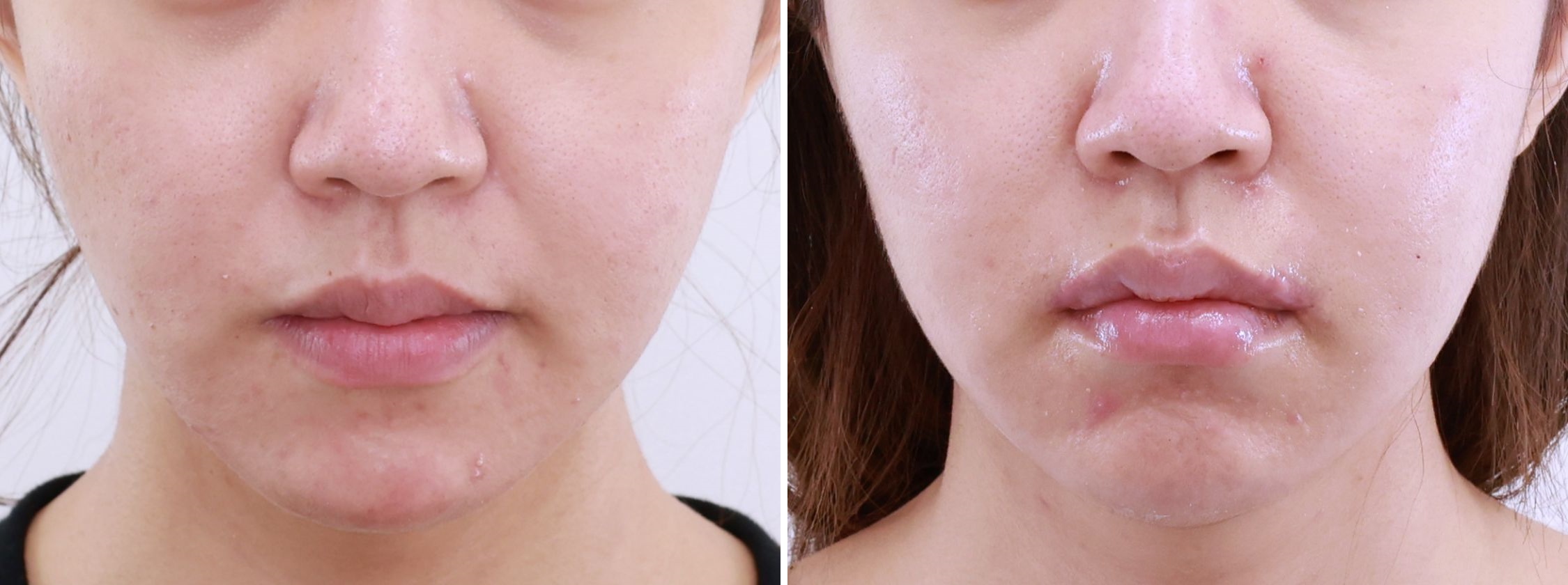 人中短縮術と口角リフトで自信ある口元に