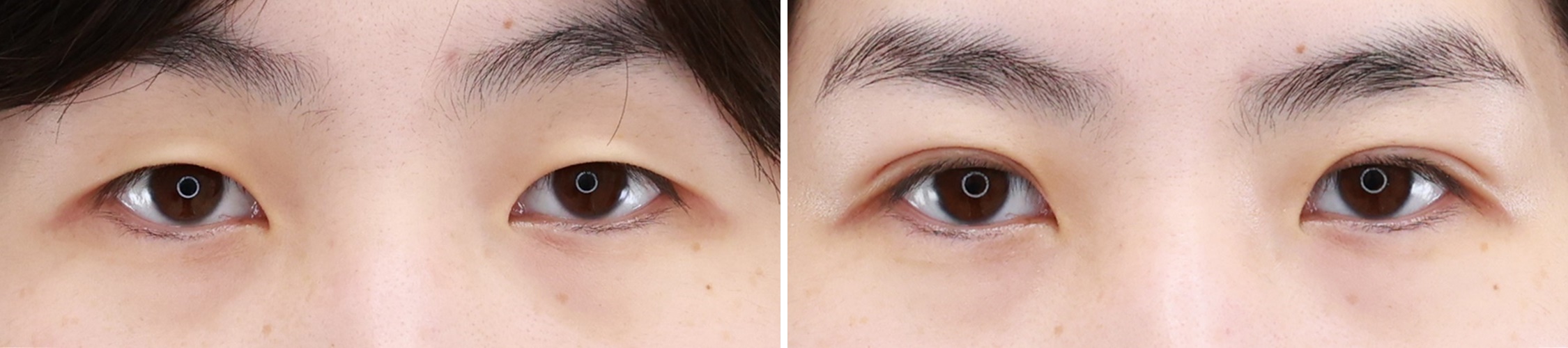 クイックコスメリングで アイプチよりも自然な二重に