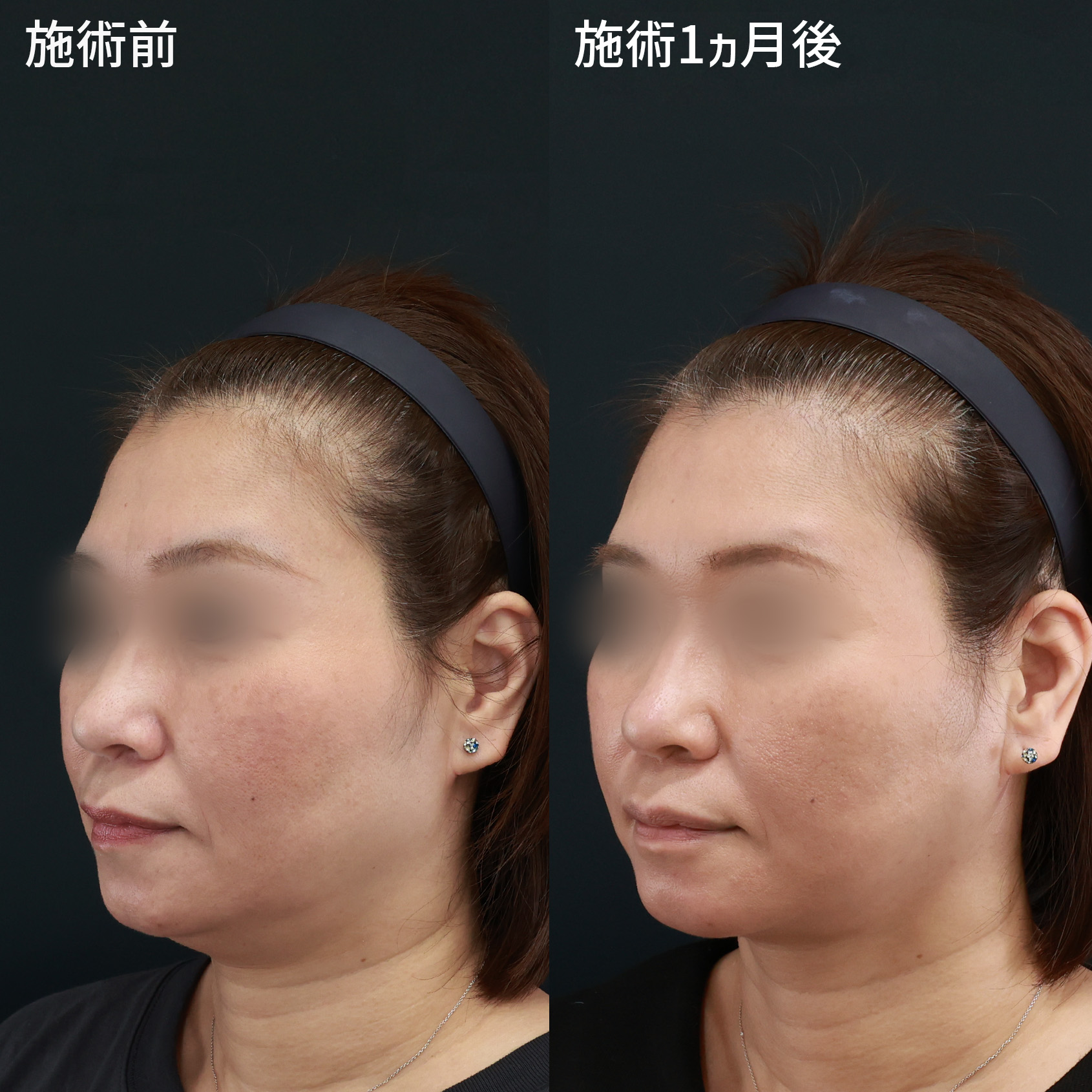 TAC式 ツヤ肌コラーゲンリフト®/顔の脂肪吸引の症例写真 施術前後  施術前・施術１ヵ月後