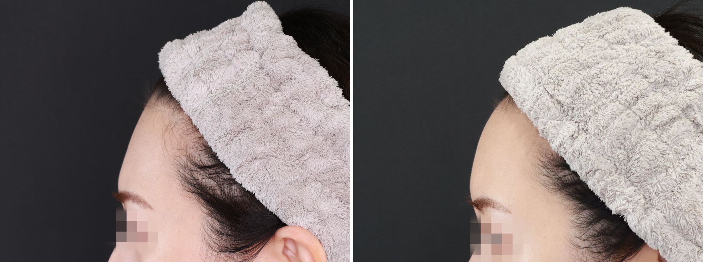 おでこの脂肪注入（オルチャンデコ形成）の症例写真 施術前後 １ヵ月