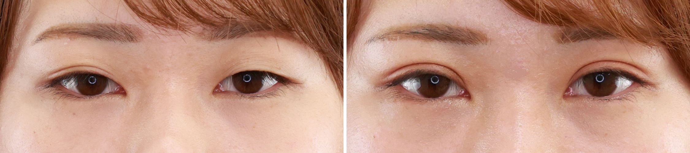 幅広めの埋没法でぱっちりとしたお目元に