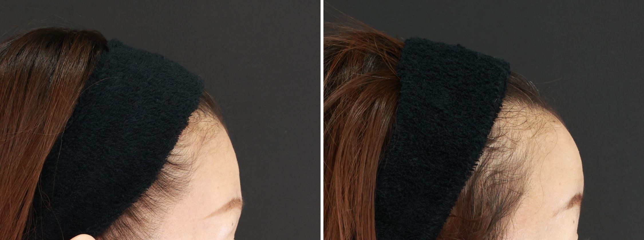 おでこの脂肪注入(オルチャンデコ形成)の症例写真 施術前後 1週間
