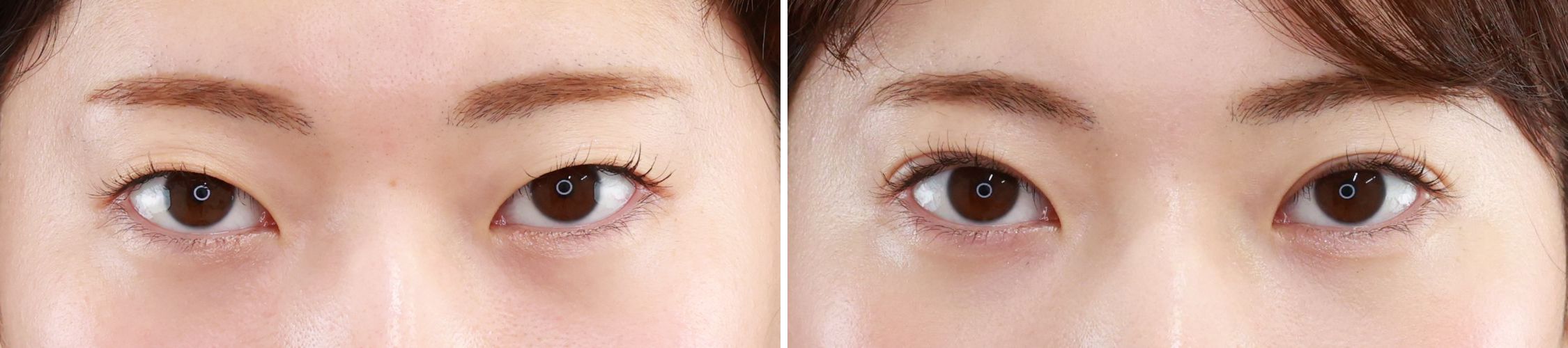 二重埋没法で自然だけど印象的なお目元に