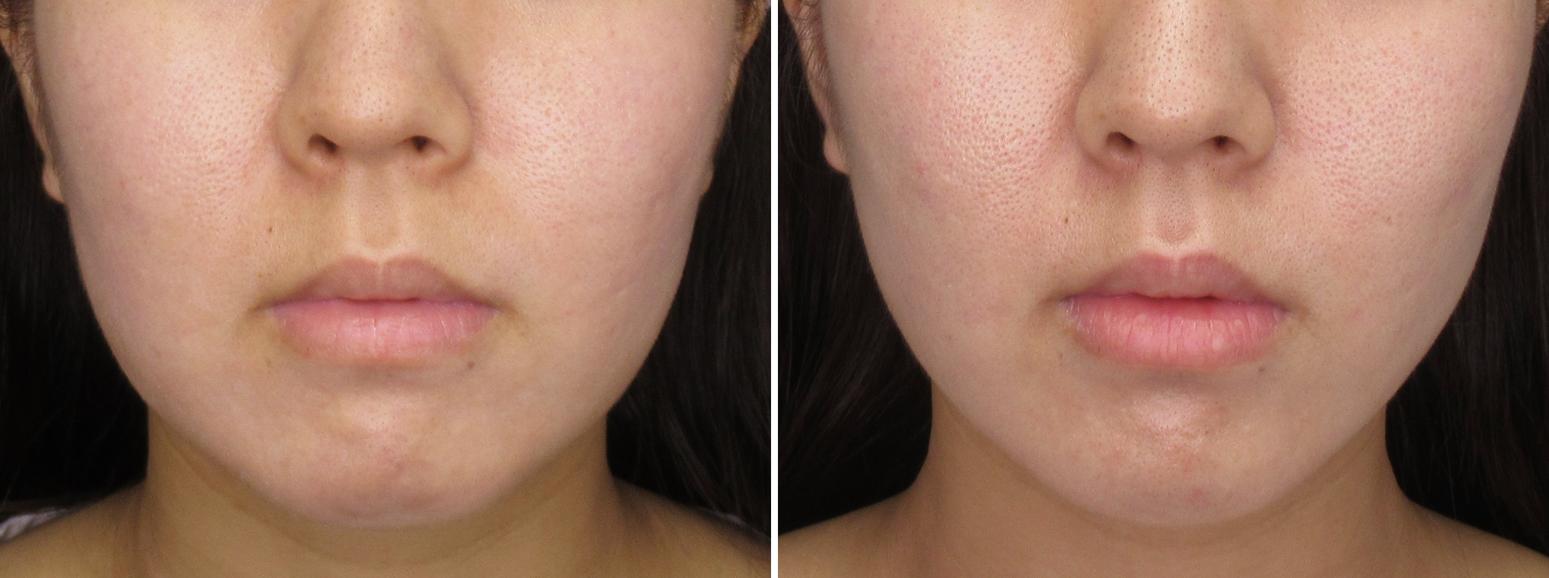 人気の複合施術ですっきりとしたフェイスラインに