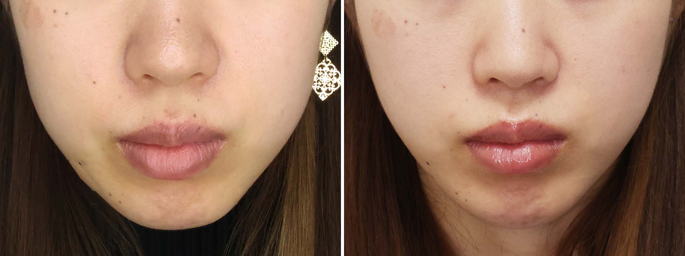 お顔のもたつきが無くなりリフトアップ！