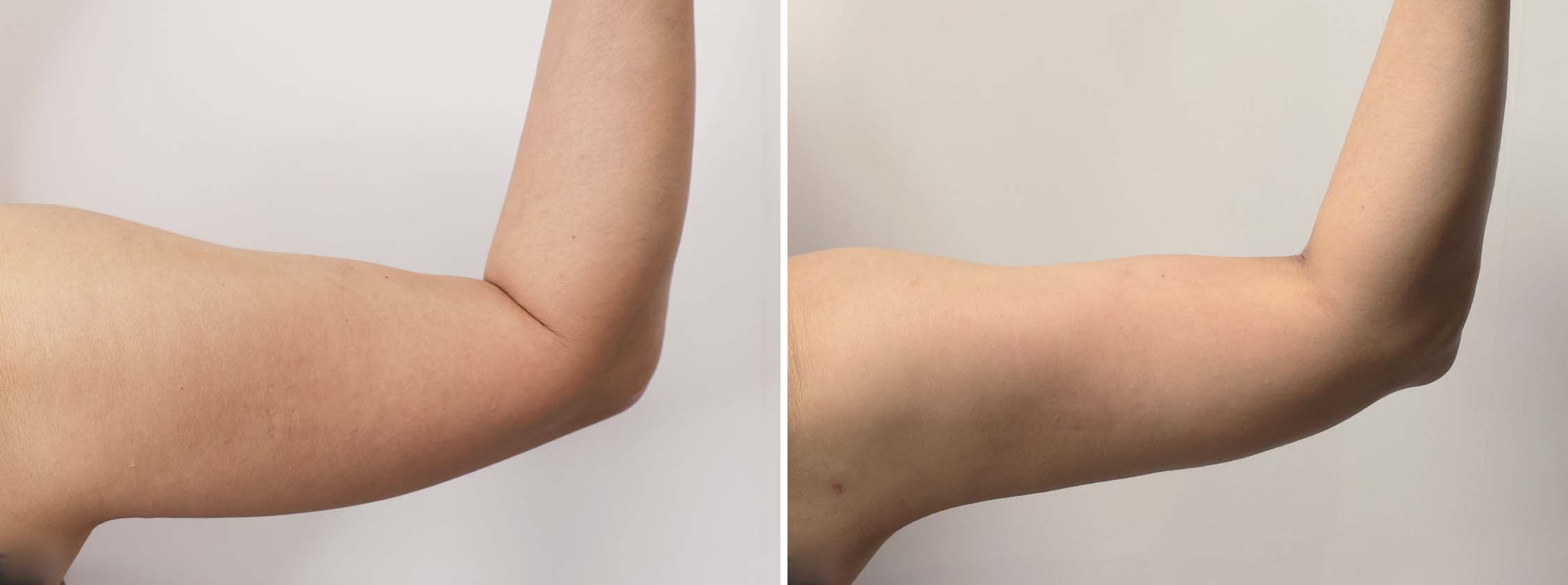 体の脂肪吸引の症例写真 施術前後 １ヵ月