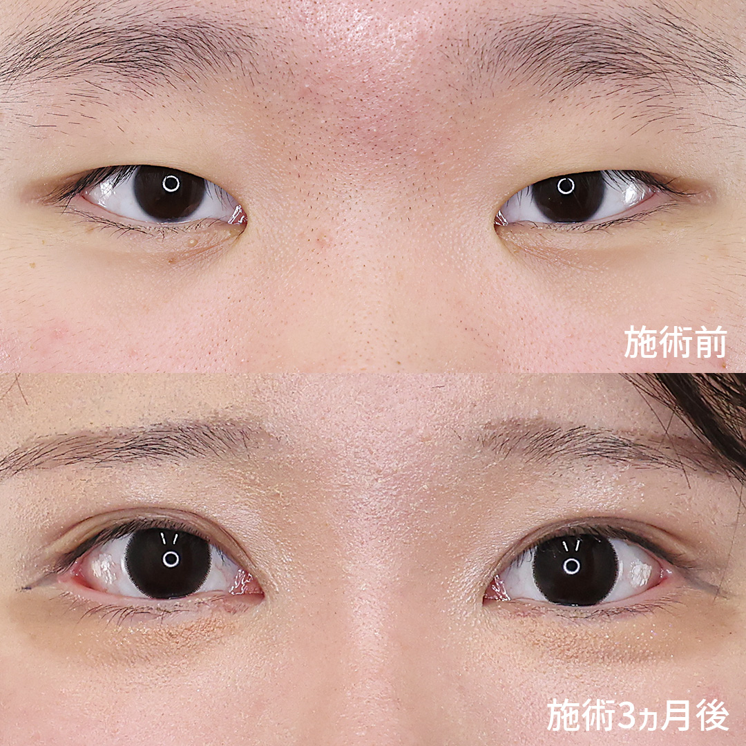 目元の印象はここまで変えられる! 複合施術で華やかなお顔立ちに!!