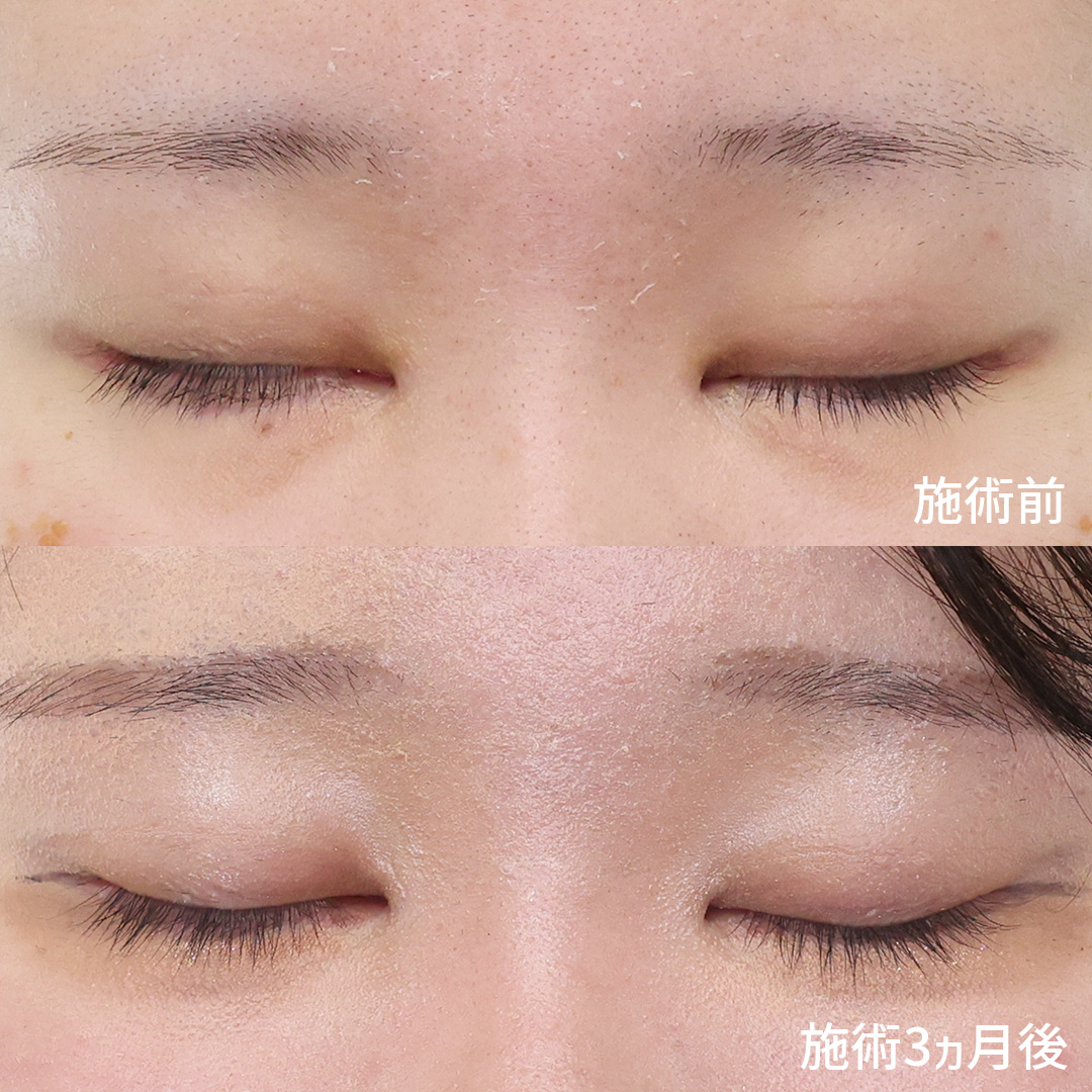 二重埋没法/目尻切開術/目頭切開術の症例写真 施術前後 