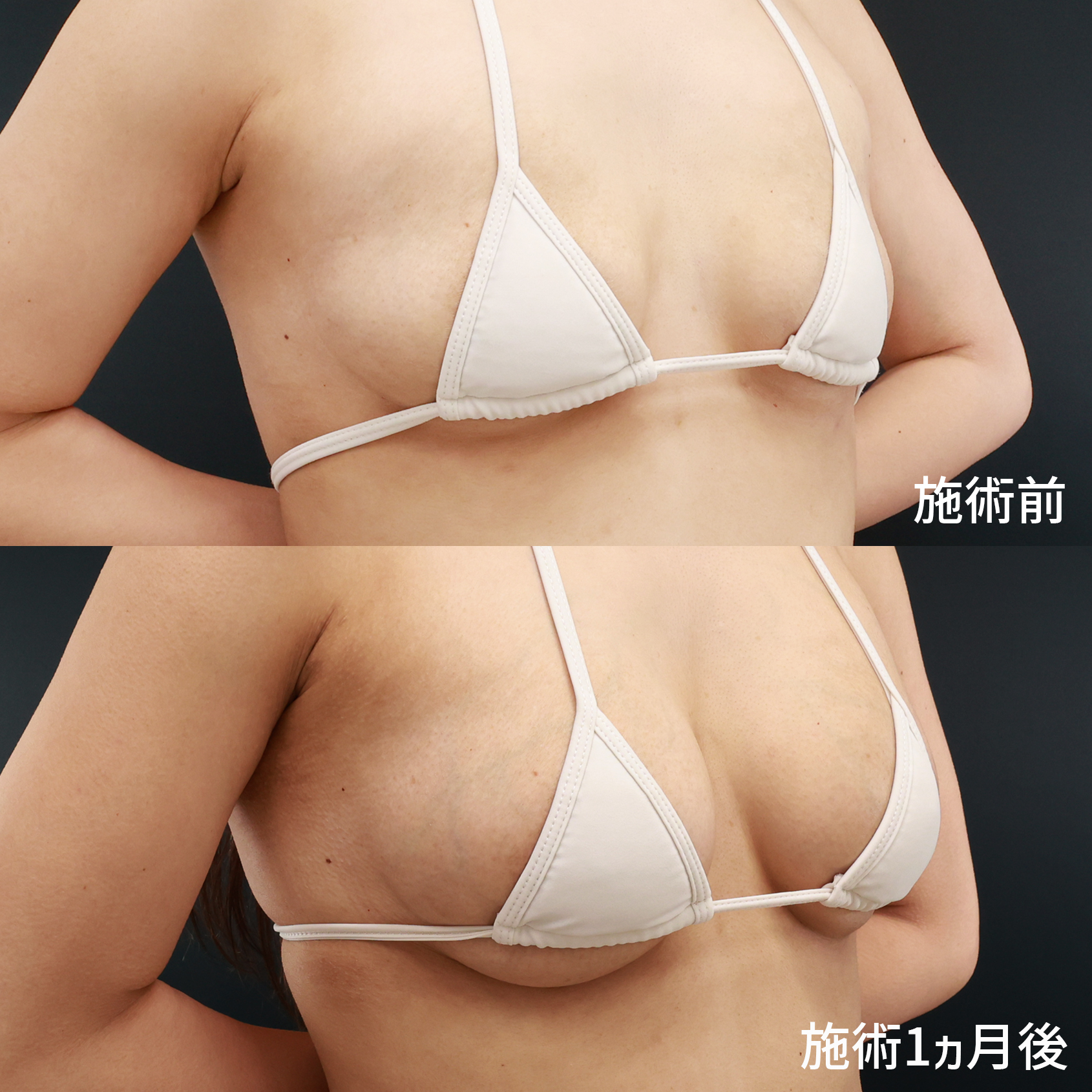 シリコンバッグ豊胸（人工乳腺バッグ）の症例写真 施術前後 1ヵ月