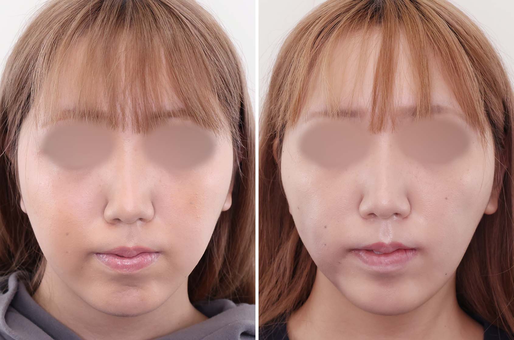 TAC式 ツヤ肌コラーゲンリフト®/ジョールファット除去/メーラーファット除去の症例写真 施術前後 2週間