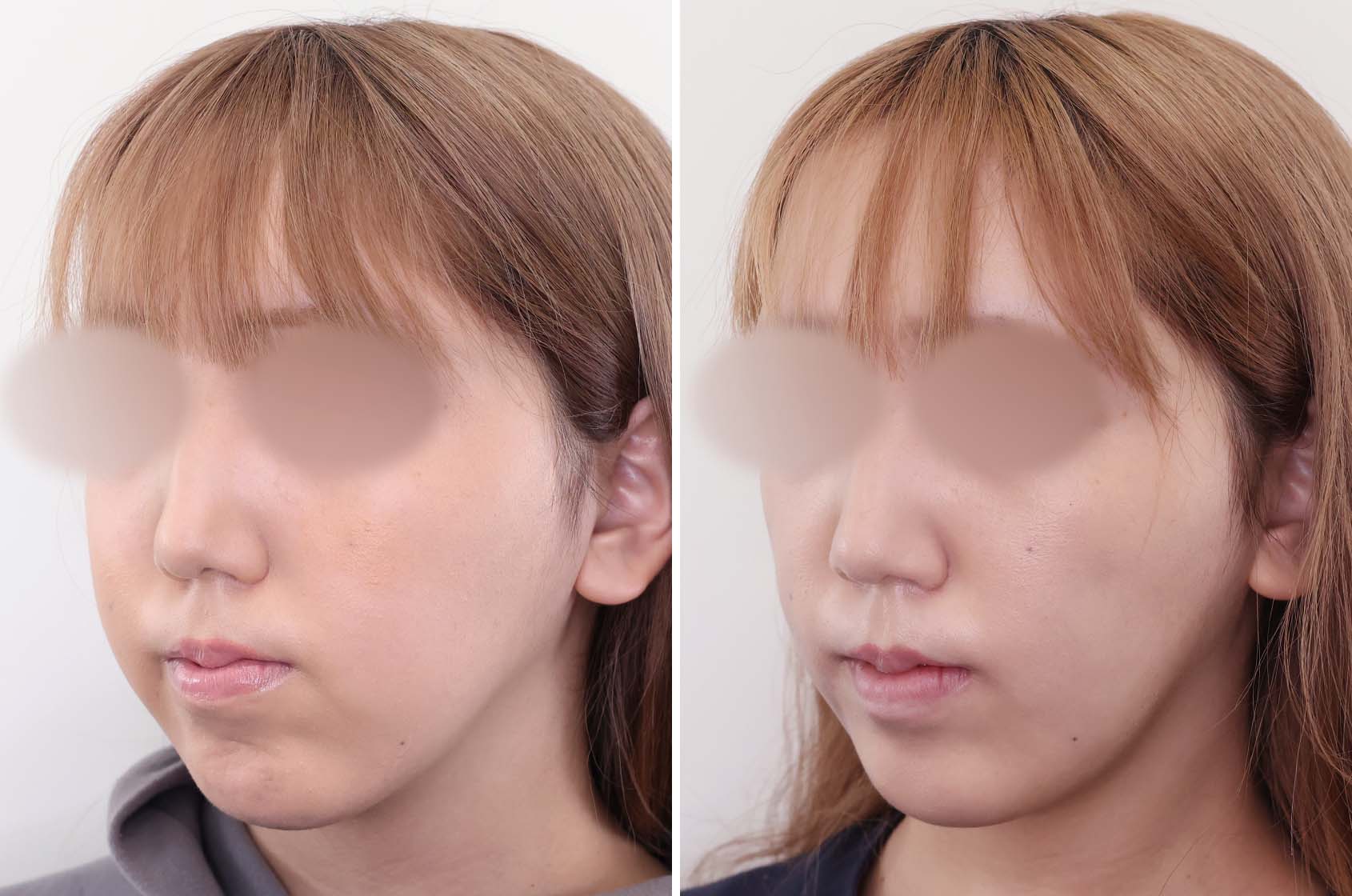 TAC式 ツヤ肌コラーゲンリフト®/ジョールファット除去/メーラーファット除去の症例写真 施術前後 2週間