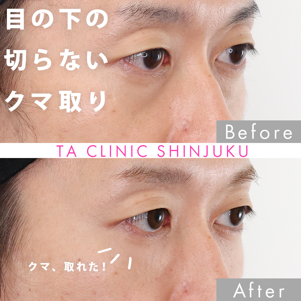 下眼瞼脱脂術（目の下のたるみ取り・目の下の脂肪ふくらみ取り）/顔の脂肪注入(コンデンスリッチフェイス)の症例写真 施術前後 