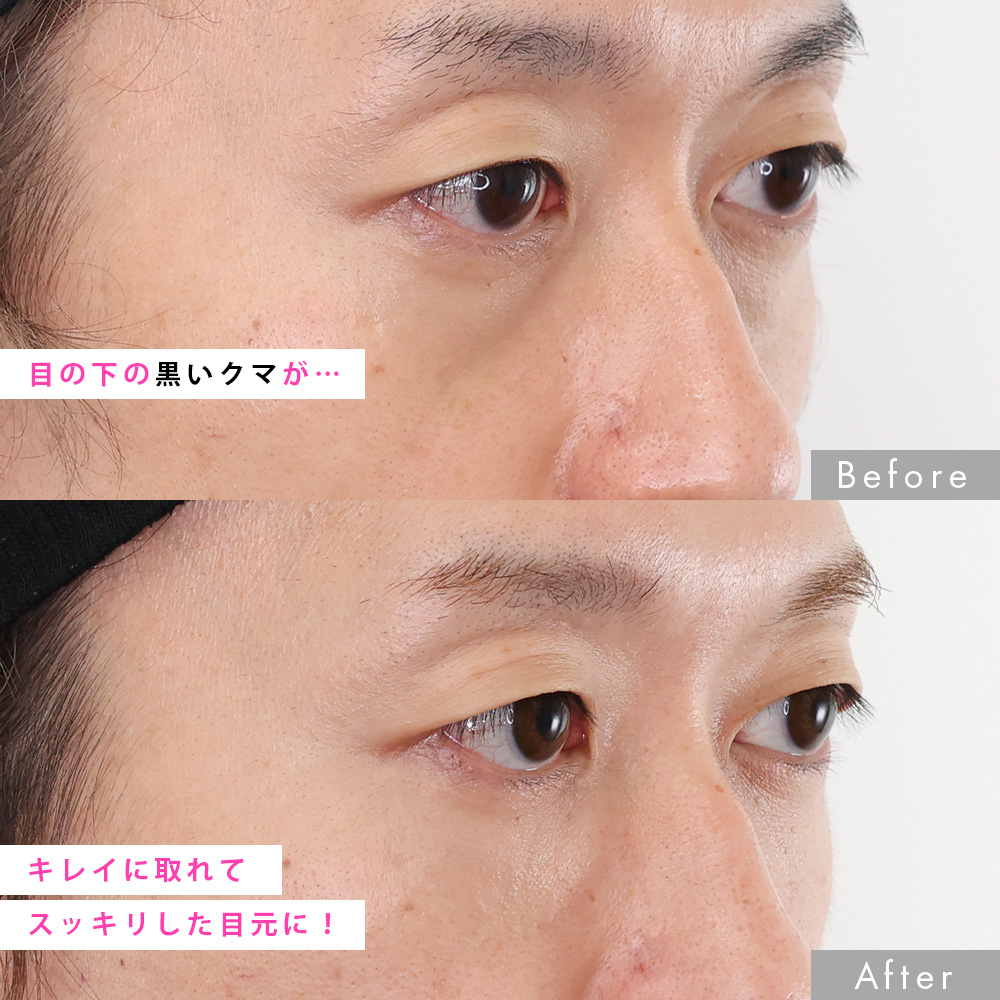 下眼瞼脱脂術（目の下のたるみ取り・目の下の脂肪ふくらみ取り）/顔の脂肪注入(コンデンスリッチフェイス)の症例写真 施術前後 