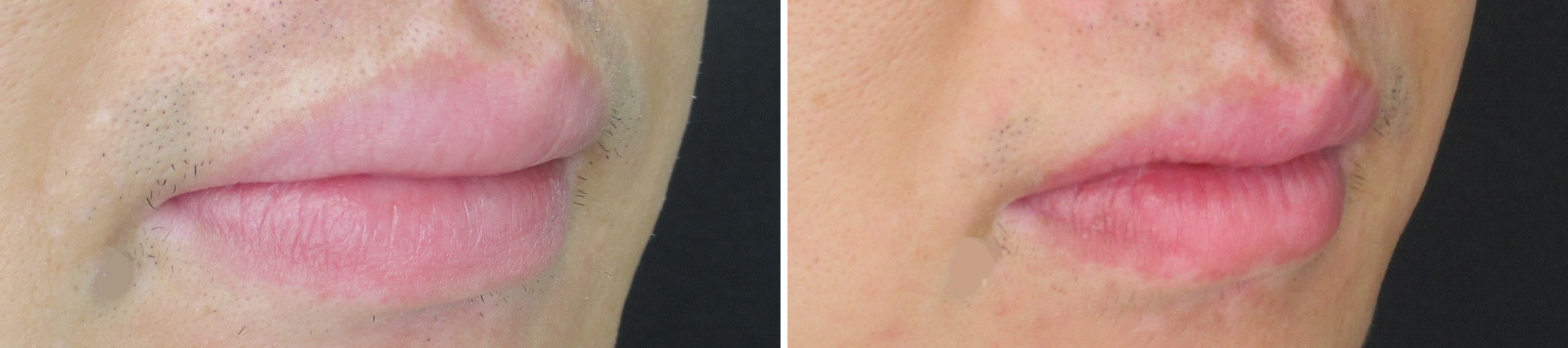 口唇縮小術の症例写真 施術前後 1ヵ月