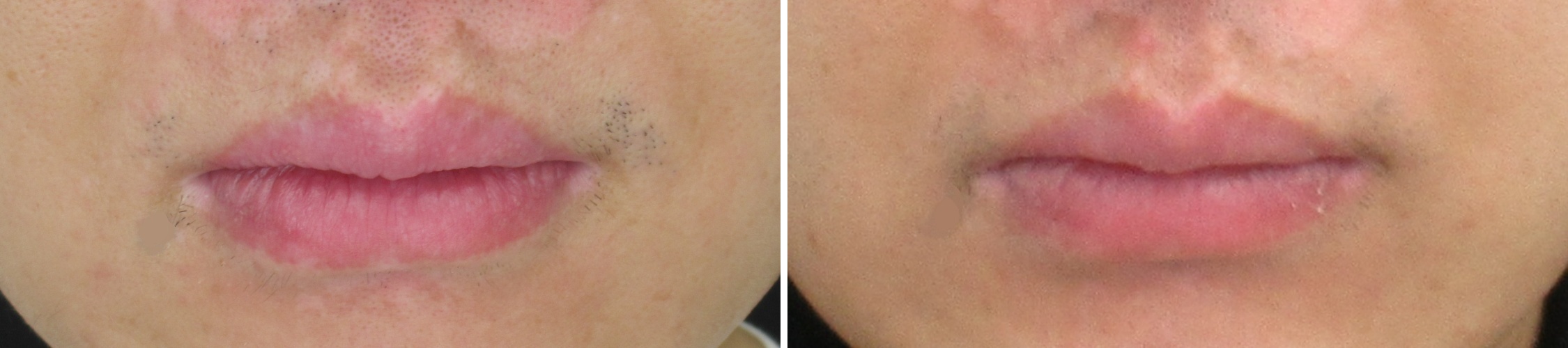 口唇縮小術の症例写真 施術前後 1ヵ月
