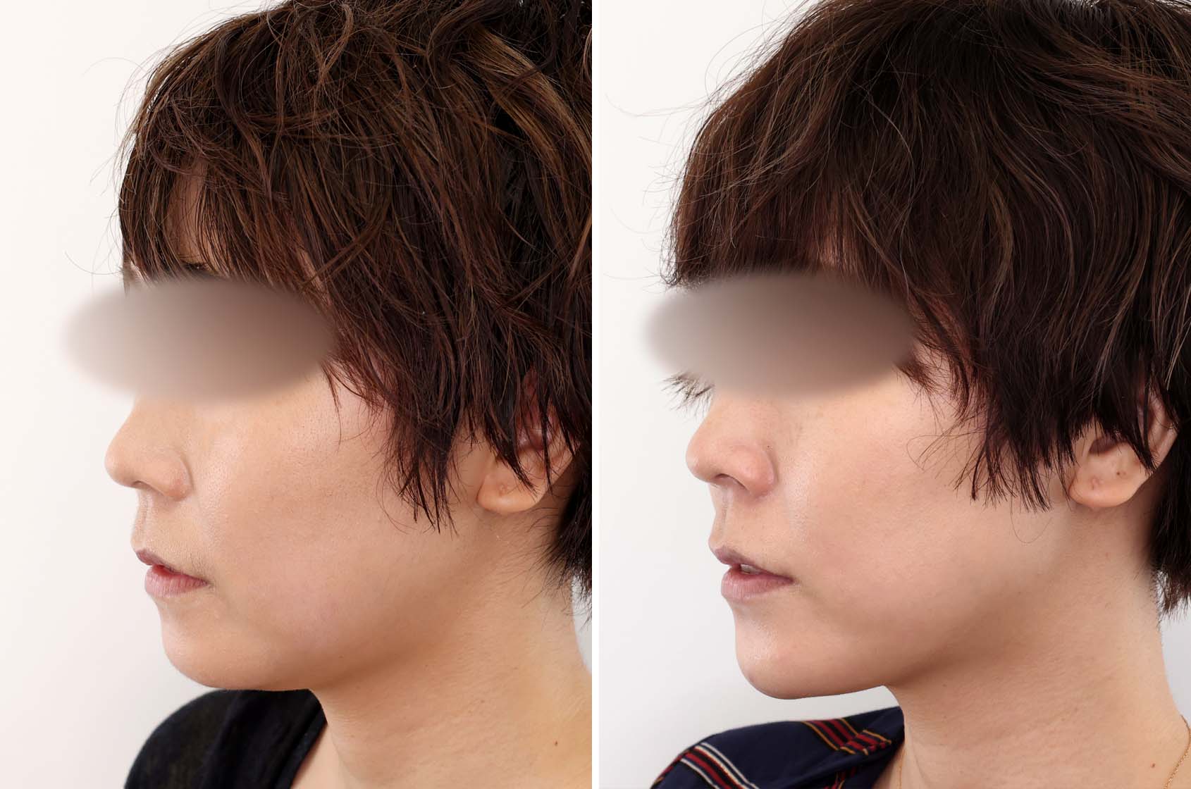 TAC式 ツヤ肌コラーゲンリフト®/ジョールファット除去/バッカルファット除去の症例写真 施術前後 1ヵ月