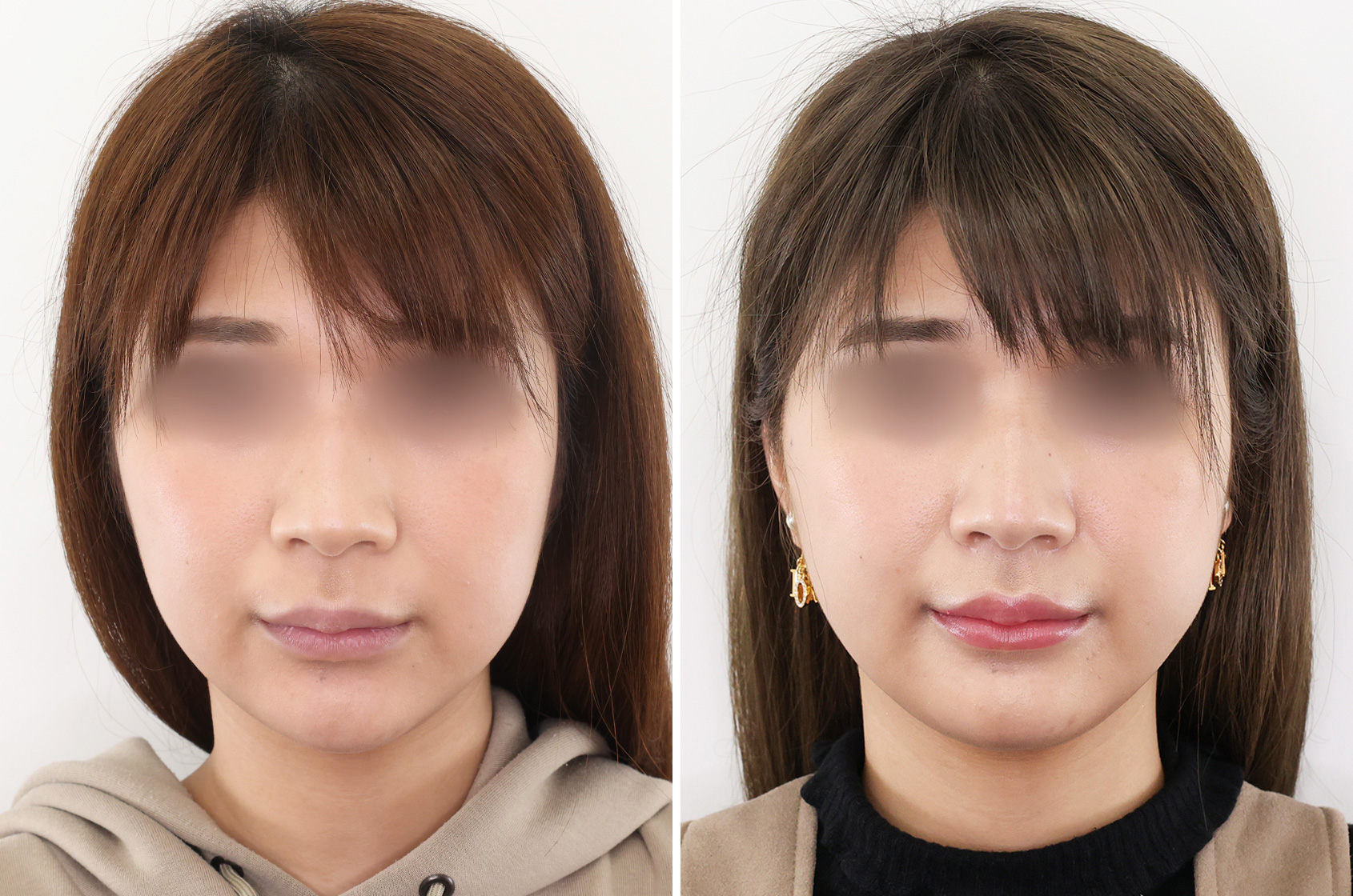 TAC式 ツヤ肌コラーゲンリフト®/ジョールファット除去の症例写真 施術前後 1ヵ月