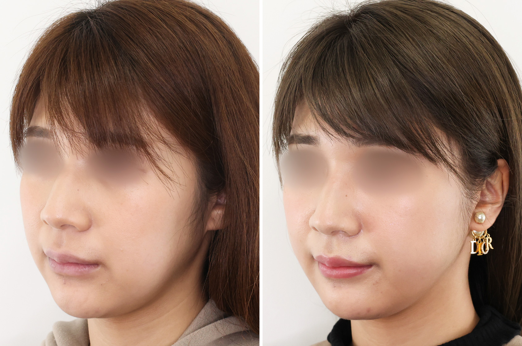 TAC式 ツヤ肌コラーゲンリフト®/ジョールファット除去の症例写真 施術前後 1ヵ月