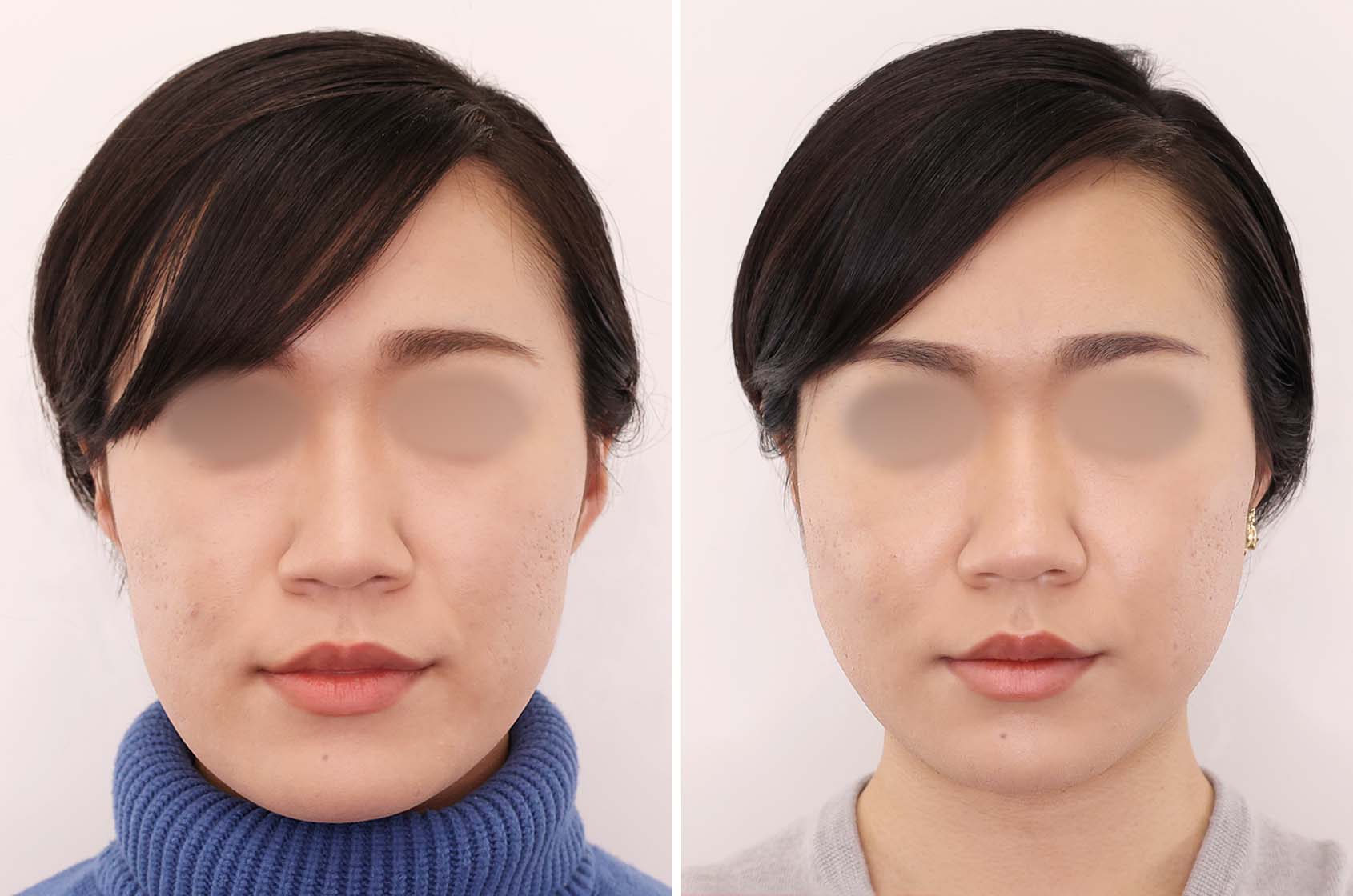 【ツヤ肌コラーゲンリフト極】で叶える！健康的な小顔美人