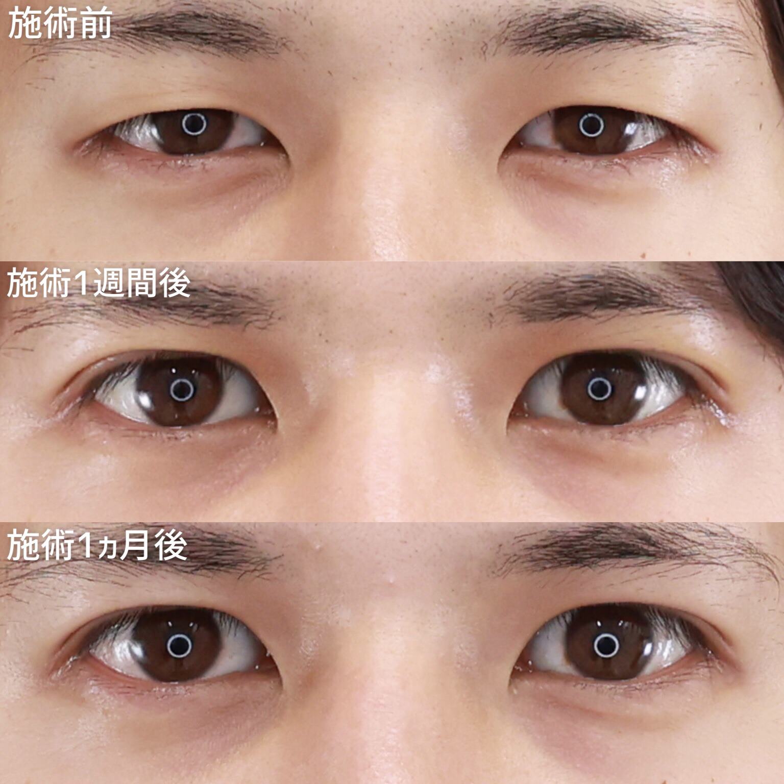 二重埋没法の症例写真 施術前後 