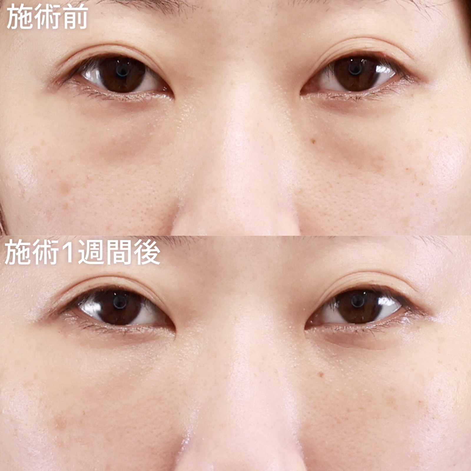 下眼瞼脱脂術(目の下のたるみ取り・目の下の脂肪ふくらみ取り)/顔の脂肪注入(コンデンスリッチフェイス)の症例写真 施術前後 1週間