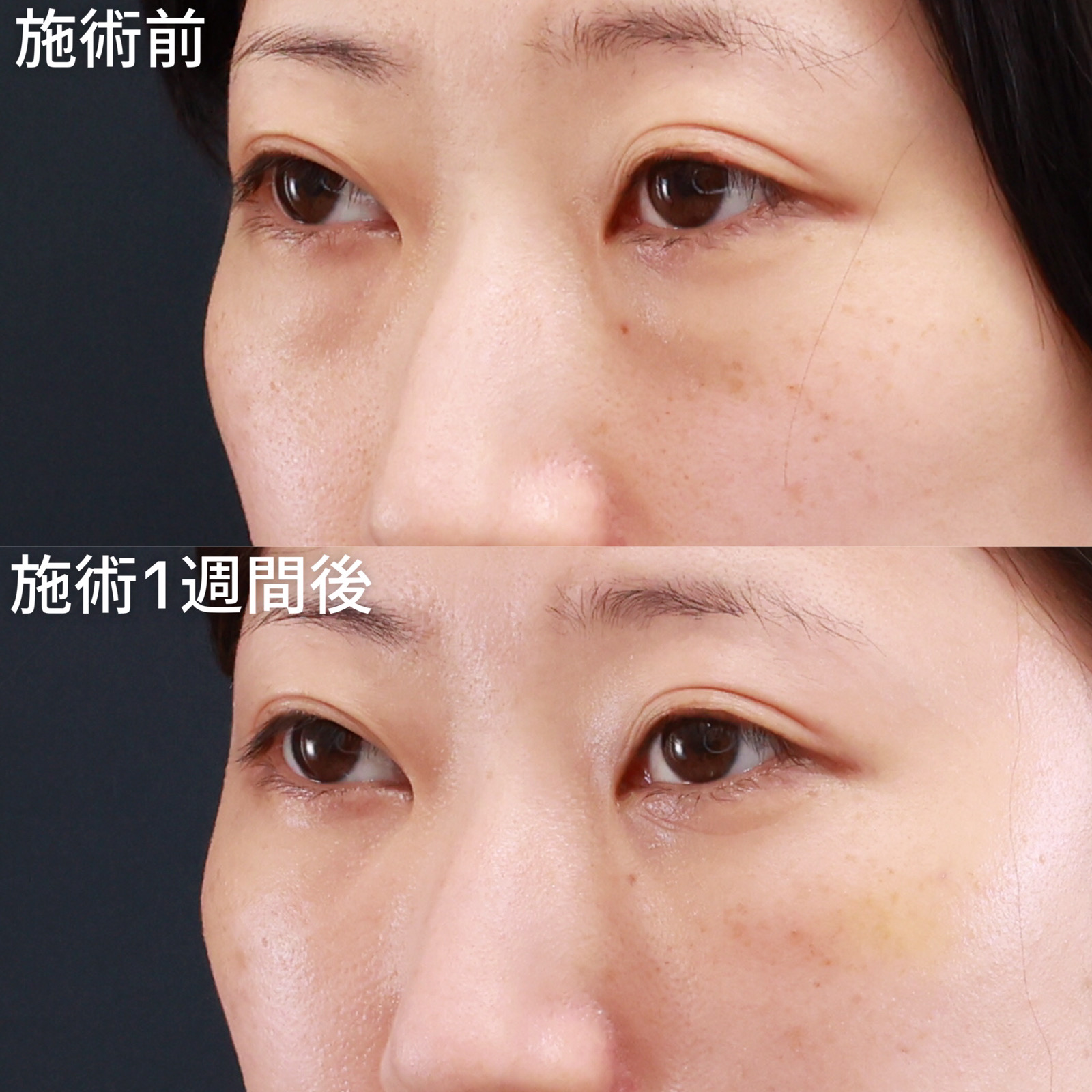 下眼瞼脱脂術(目の下のたるみ取り・目の下の脂肪ふくらみ取り)/顔の脂肪注入(コンデンスリッチフェイス)の症例写真 施術前後