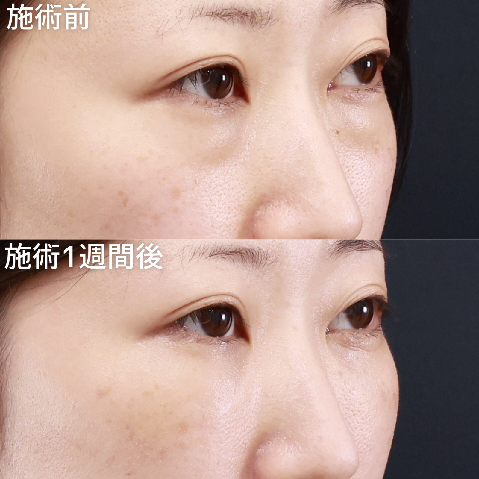 下眼瞼脱脂術(目の下のたるみ取り・目の下の脂肪ふくらみ取り)/顔の脂肪注入(コンデンスリッチフェイス)の症例写真 施術前後