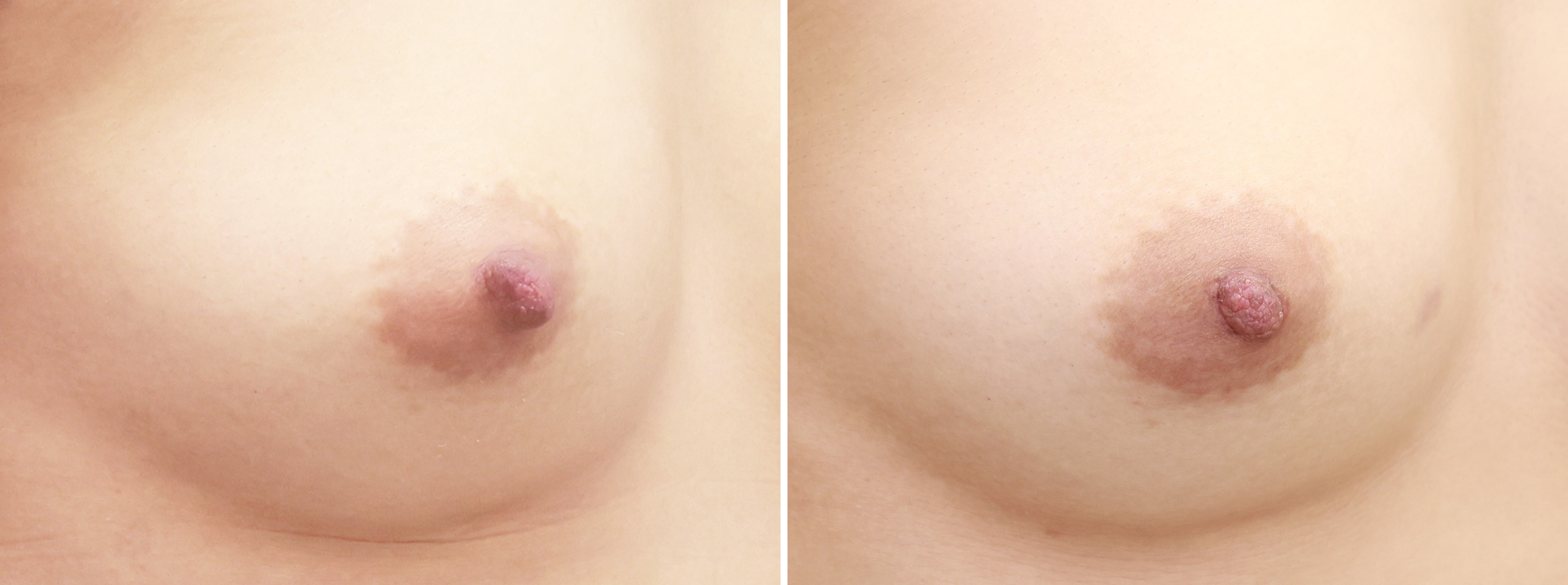乳頭縮小術の症例写真 施術前後 １ヵ月