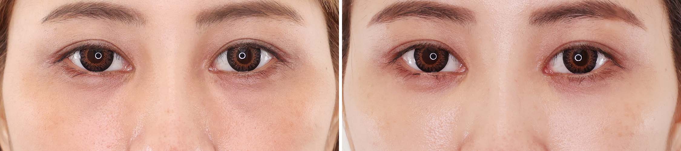 実年齢より上に見られる原因は「クマ」！？クマ取りと脂肪注入で印象-10歳