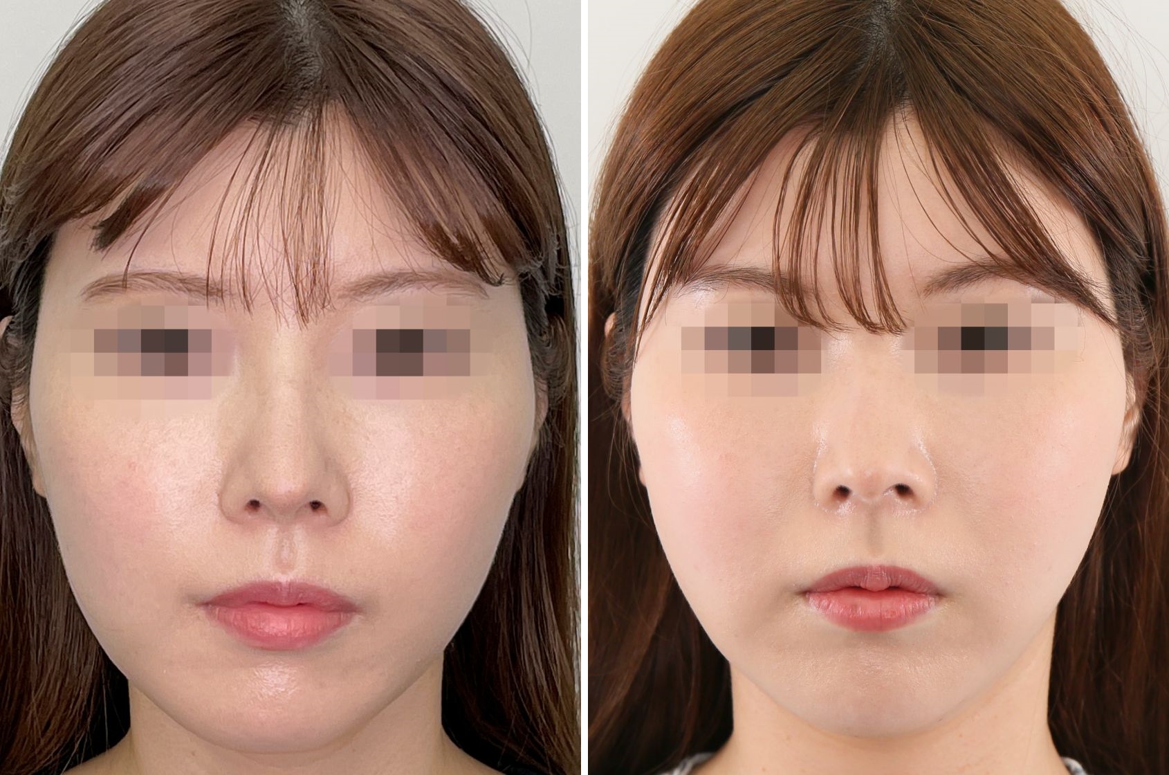 「ツヤ肌コラーゲンリフト®極」&「脂肪吸引」でスッキリとしたフェイスラインに！