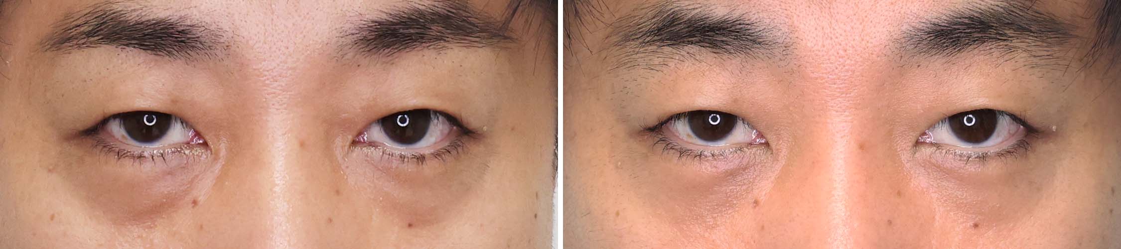 下眼瞼脱脂術（目の下のたるみ取り・目の下の脂肪ふくらみ取り）/顔の脂肪注入(コンデンスリッチフェイス)の症例写真 施術前後 1ヵ月