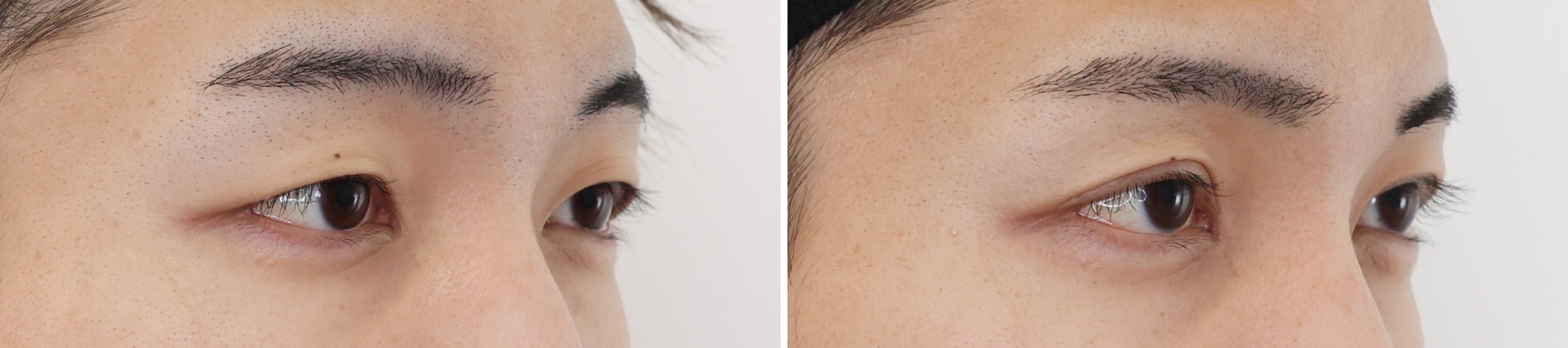 二重埋没法の症例写真 施術前後 1ヵ月