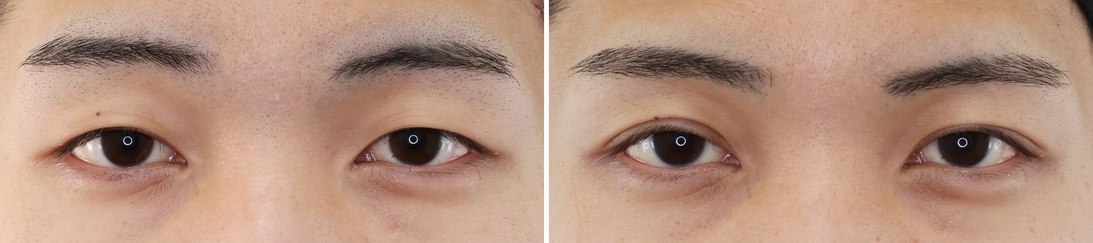 メンズの埋没二重はさりげなさがカギ！少しの変化で一気に垢抜けイケメンに