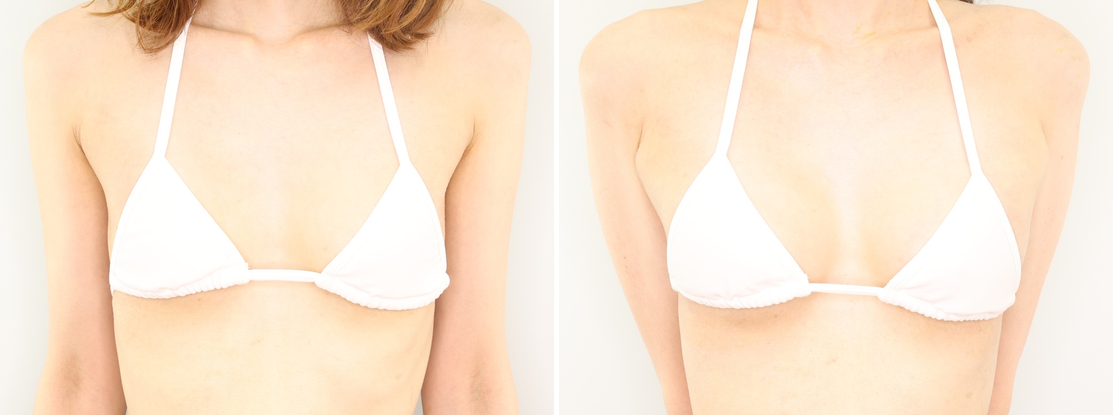 ヒアルロン酸注入豊胸術(グラビアバスト)の症例写真 施術前後 直後