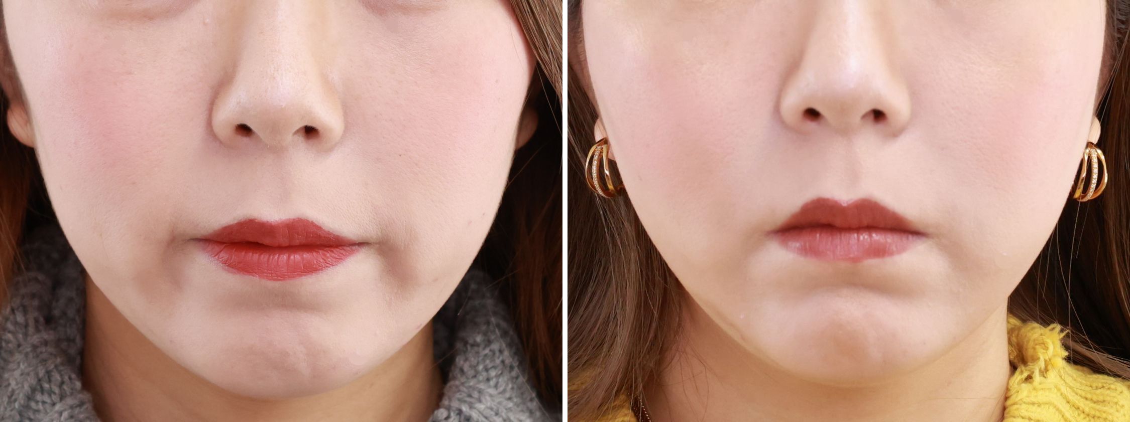糸リフトなど人気の複合施術でお顔周りのもたつきがスッキリ