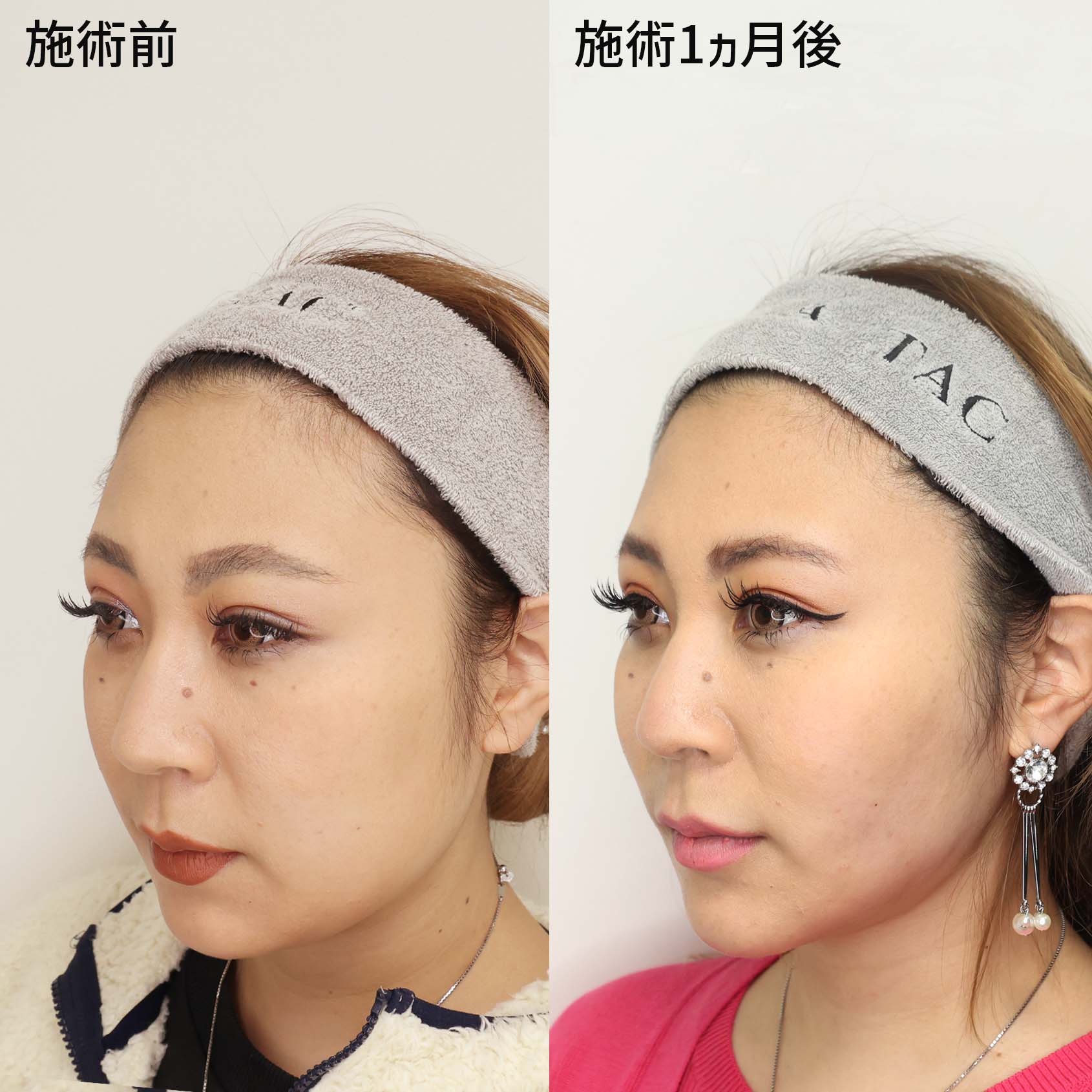 TAC式 ツヤ肌コラーゲンリフト®/ジョールファット除去/バッカルファット除去の症例写真 施術前後 施術前・施術１ヵ月後