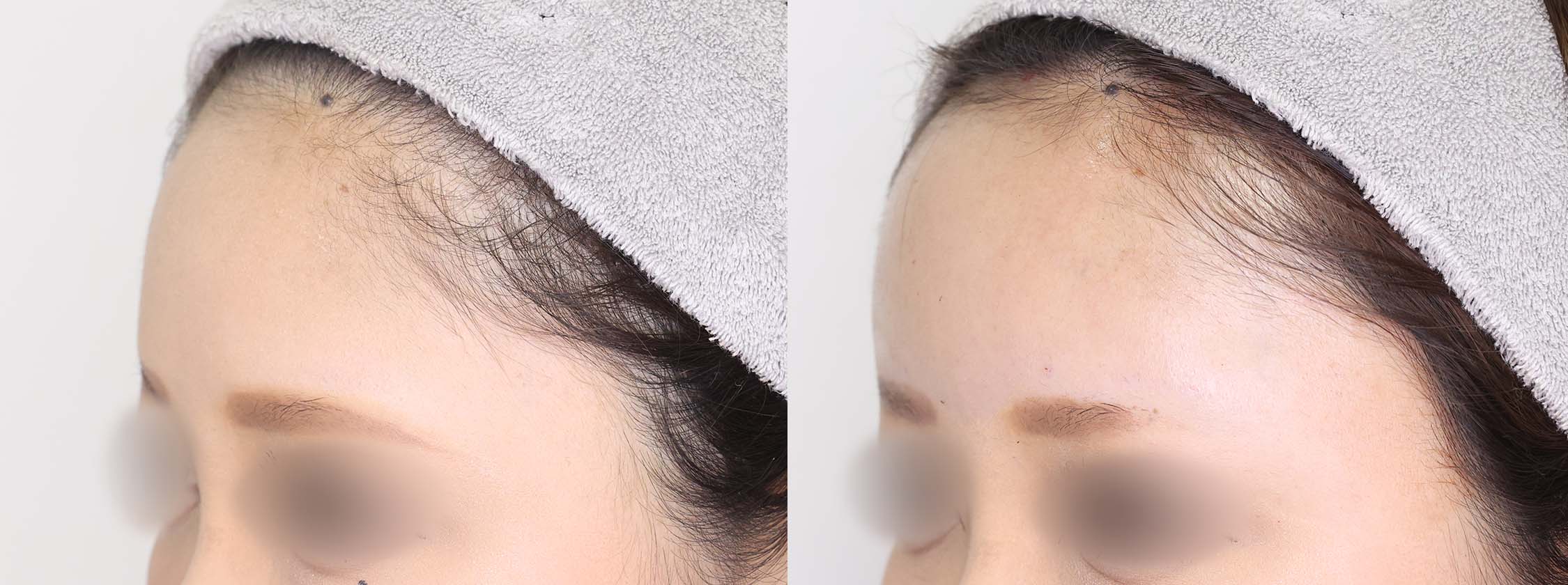 おでこの脂肪注入（オルチャンデコ形成）の症例写真 施術前後 直後
