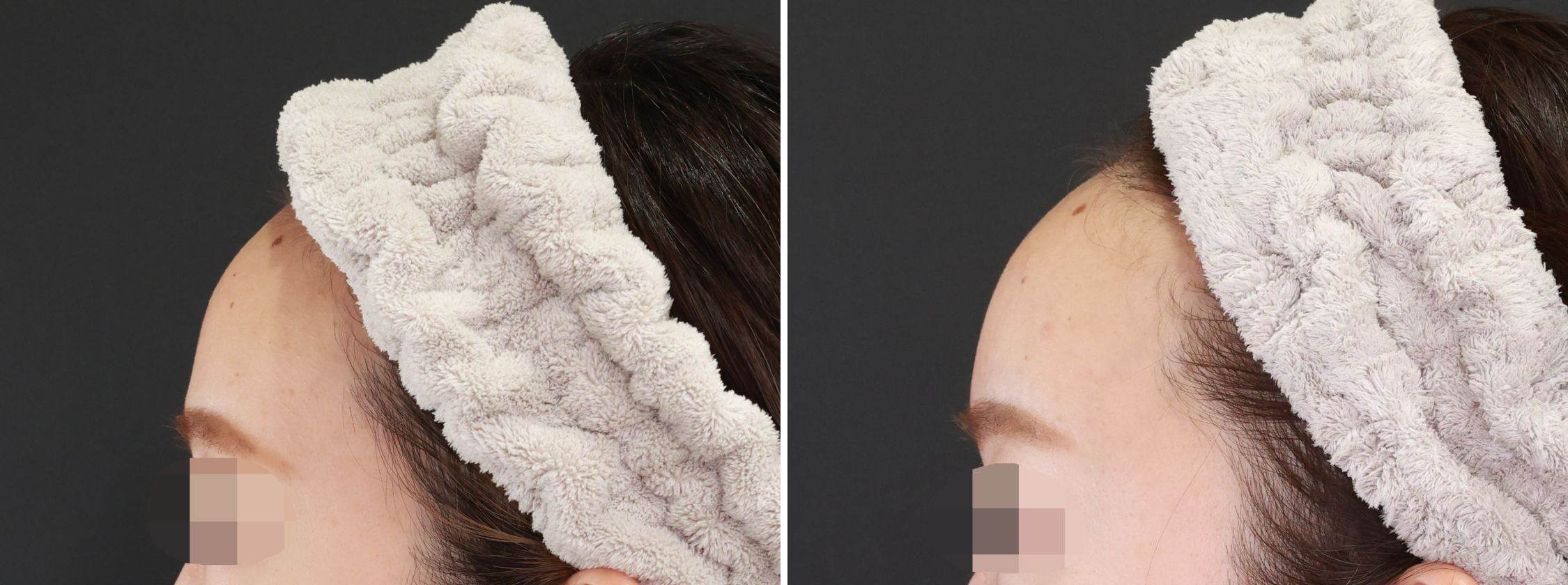 おでこの脂肪注入（オルチャンデコ形成）の症例写真 施術前後 １ヵ月