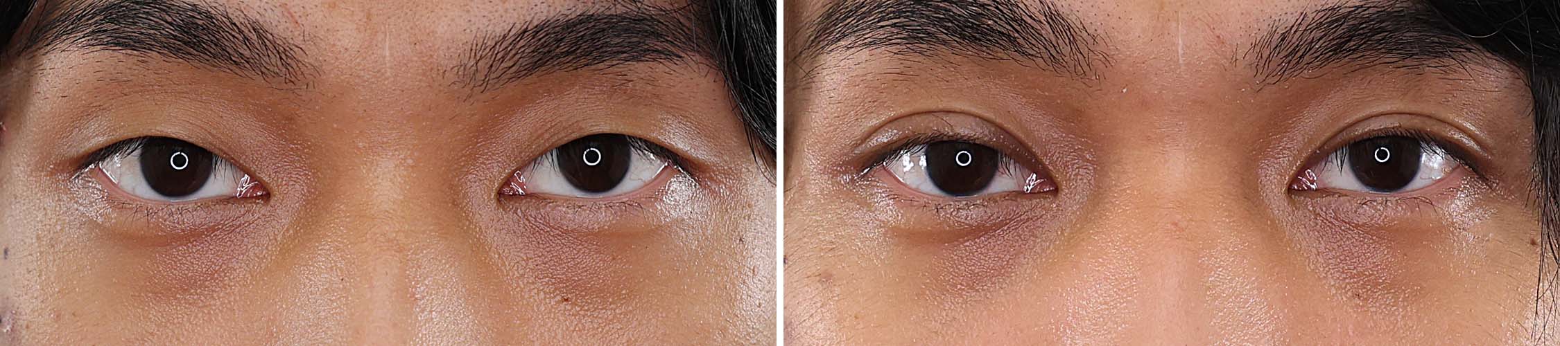 男性人気No.1！末広二重でナチュラルな目力をGET【埋没法】