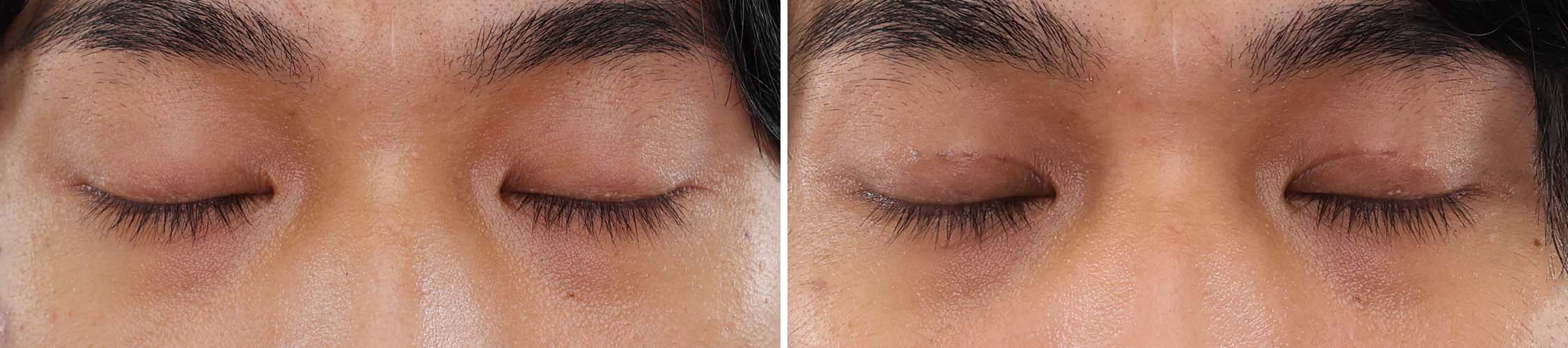 二重埋没法の症例写真 施術前後 1ヵ月