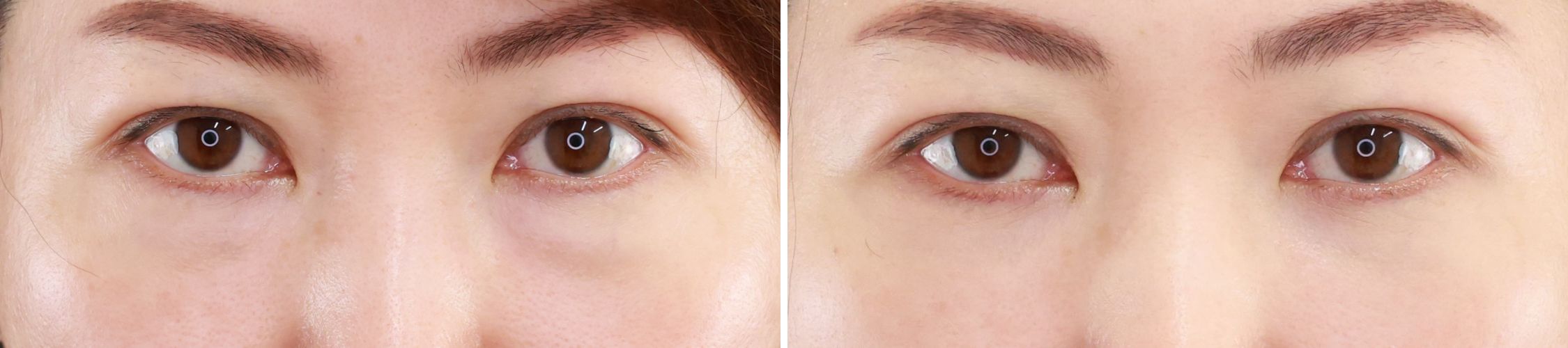 下眼瞼脱脂術と脂肪注入で若々しいお目元へ