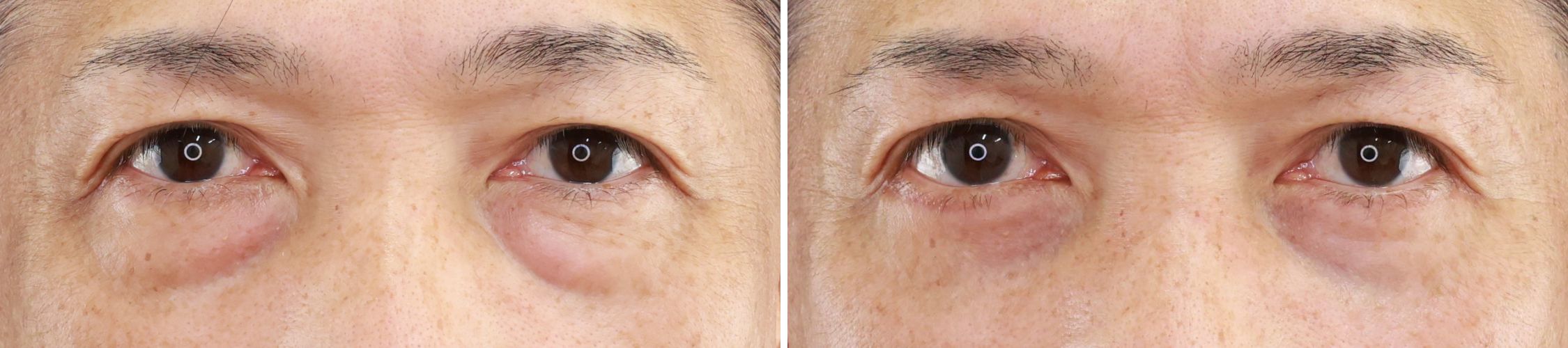 下眼瞼切開術・脱脂術と脂肪注入で目元の若返り