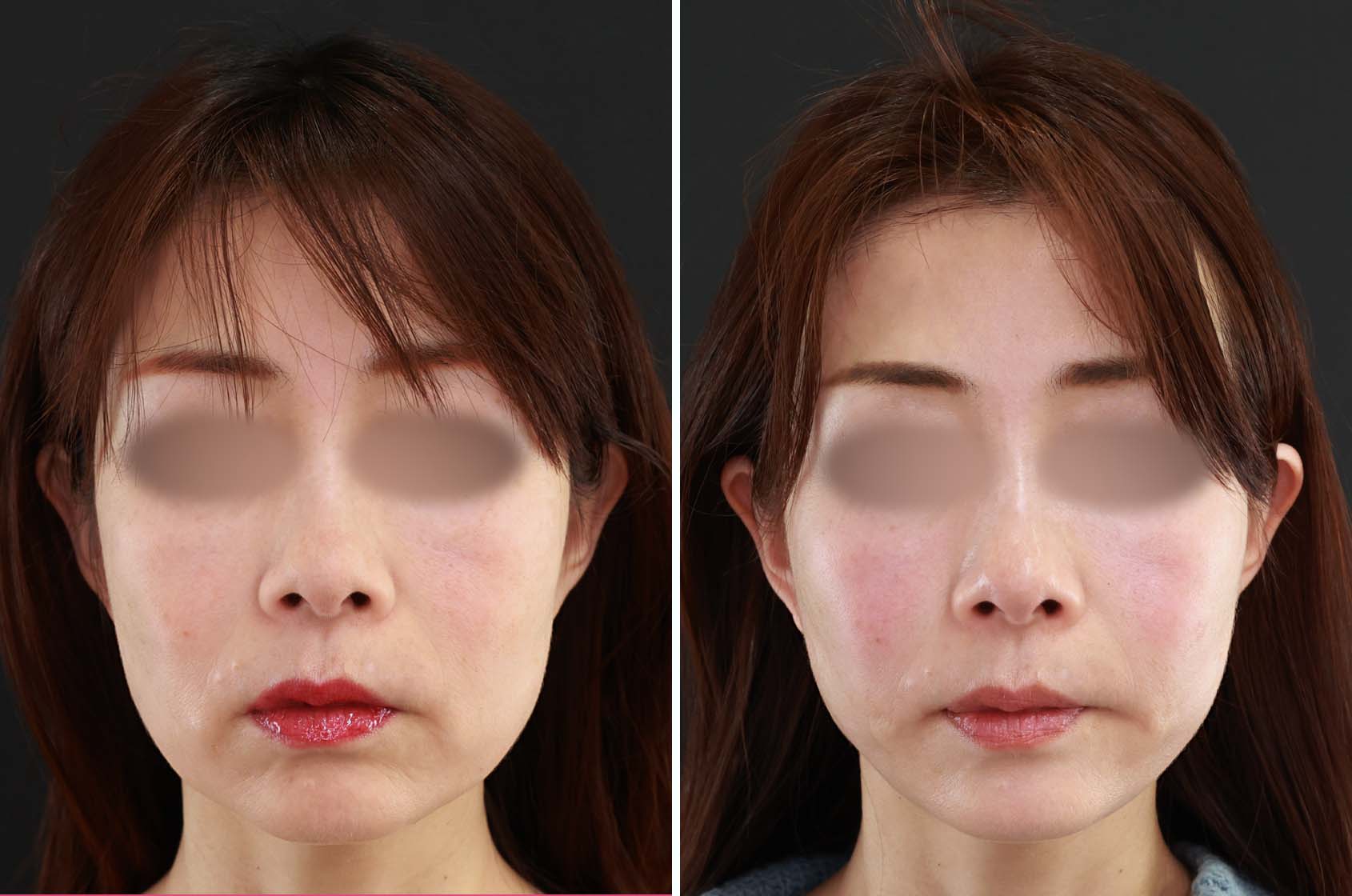 エイジングケアのニューノーマル！【糸リフト ツヤ肌コラーゲンリフト極】で40代の若返りをしっかりサポート！