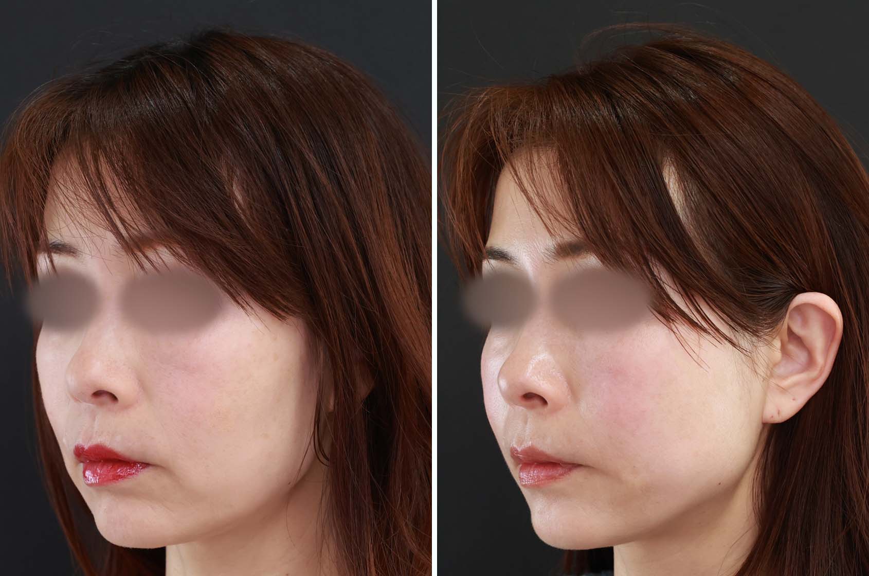 TAC式 ツヤ肌コラーゲンリフト®/ジョールファット除去の症例写真 施術前後 1ヵ月