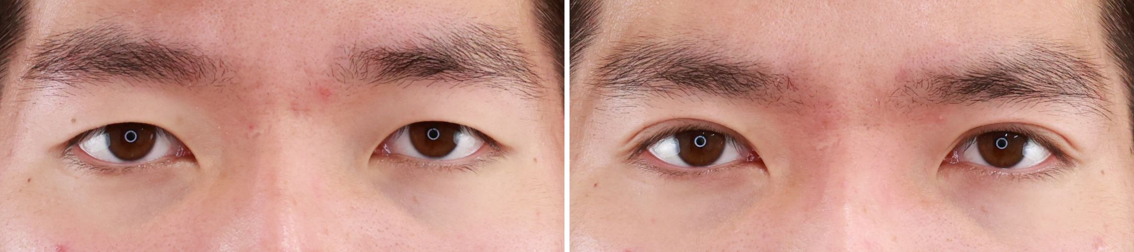 埋没法で目力アップの二重へ