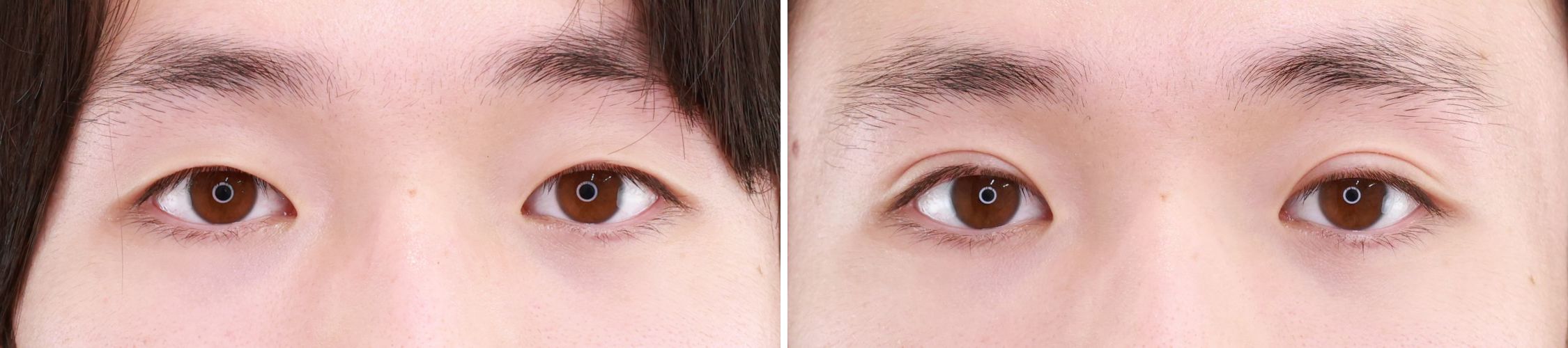 二重埋没法の症例写真 施術前後 １ヵ月