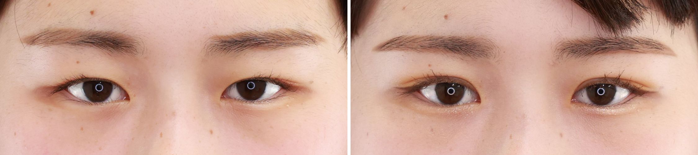 二重埋没法/目元：その他の症例写真 施術前後 1ヵ月