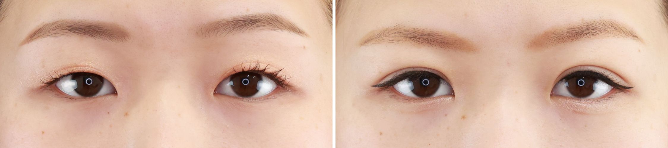 二重埋没法/目元：その他の症例写真 施術前後 １ヵ月