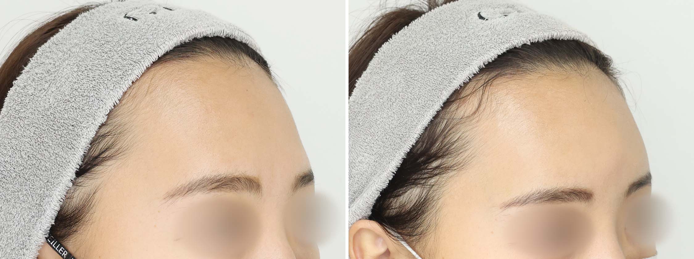 おでこの脂肪注入（オルチャンデコ形成）の症例写真 施術前後 １ヵ月